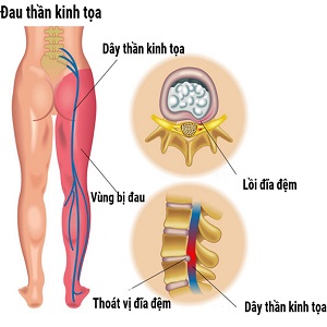 Đau lưng, Thần kinh tọa
